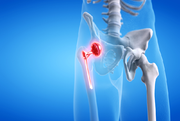 Hip Replacement